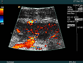 renal transplant